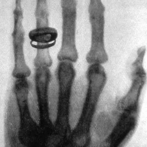 x-ray